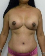 Breast Augmentation