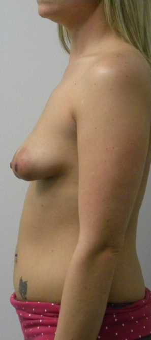 Breast Augmentation