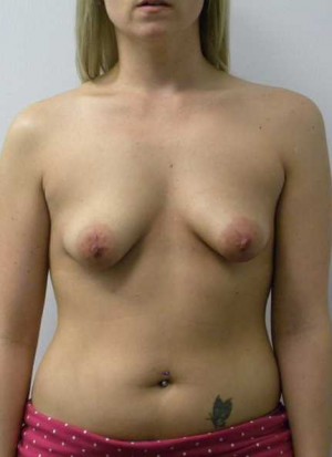 Breast Augmentation