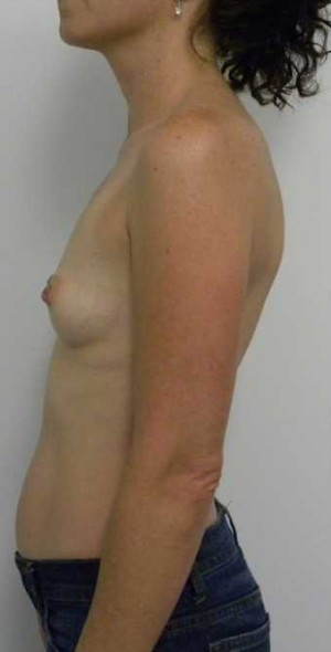 Breast Augmentation