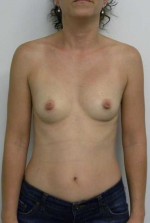Breast Augmentation