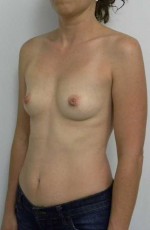 Breast Augmentation