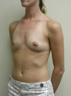 Breast Augmentation