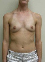 Breast Augmentation