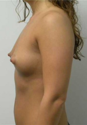 Breast Augmentation Case 5276 Before Photo Breast Augmentation