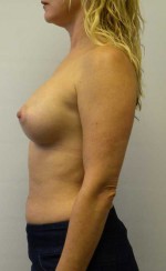 Breast Augmentation