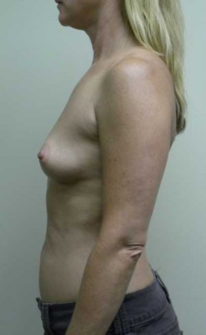 Breast Augmentation