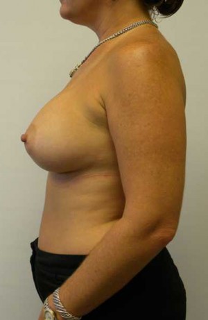 Breast Augmentation Case 5297 After Photo Breast Augmentation