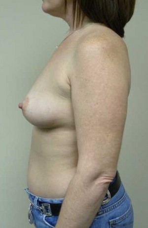 Breast Augmentation Case 5297 Before Photo Breast Augmentation