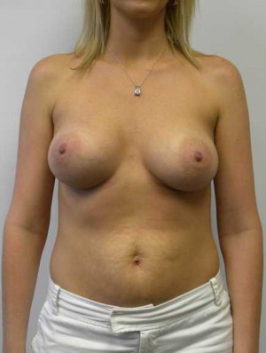 Breast Augmentation Case 5311 After Photo Breast Augmentation