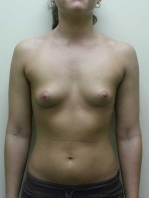 Breast Augmentation Case 5318 Before Photo Breast Augmentation