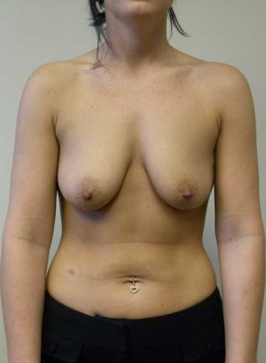 Breast Augmentation Case 5332 Before Photo Breast Augmentation