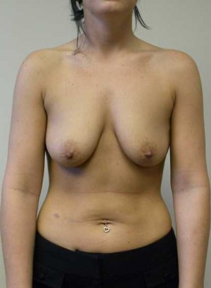 Breast Augmentation