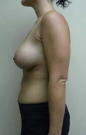 Breast Augmentation Case 5332 After Photo Breast Augmentation