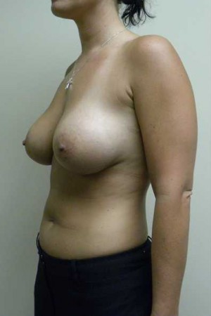 Breast Augmentation Case 5332 After Photo Breast Augmentation