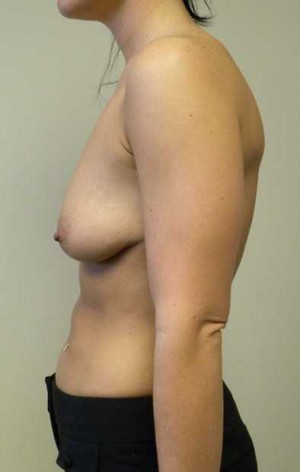 Breast Augmentation Case 5332 Before Photo Breast Augmentation