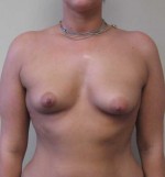 Breast Augmentation