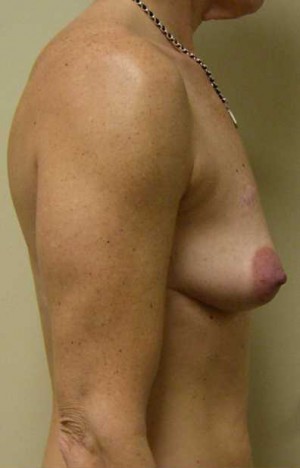 Breast Augmentation Case 5353 Before Photo Breast Augmentation