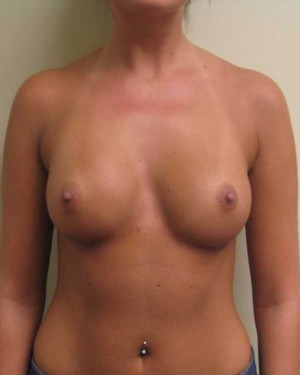 Breast Augmentation Case 5360 After Photo Breast Augmentation