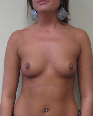 Breast Augmentation Case 5360 Before Photo Breast Augmentation