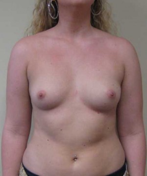 Breast Augmentation Case 5367 Before Photo Breast Augmentation