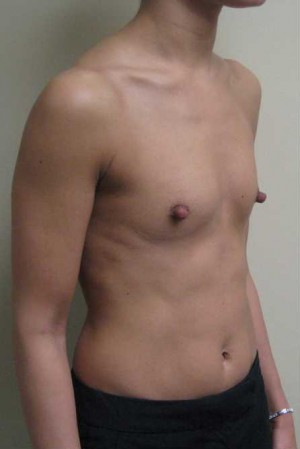Breast Augmentation Case 5374 Before Photo Breast Augmentation