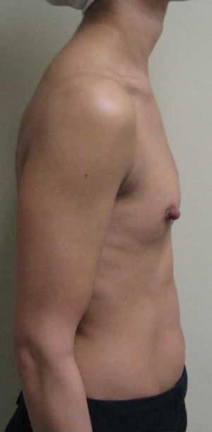Breast Augmentation Case 5374 Before Photo Breast Augmentation