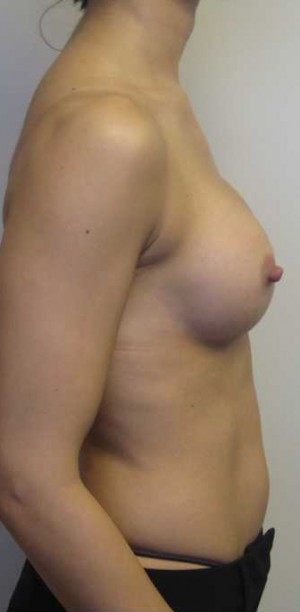 Breast Augmentation Case 5374 After Photo Breast Augmentation