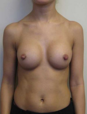 Breast Augmentation Case 5374 After Photo Breast Augmentation
