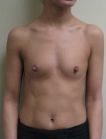 Breast Augmentation