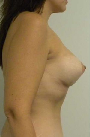 Breast Lift Case 5381 After Photo Breast Lift