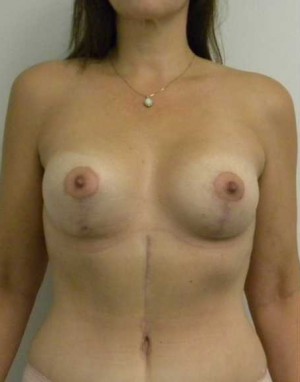 Breast Lift Case 5381 After Photo Breast Lift