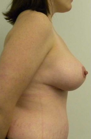 Breast Lift Case 5395 After Photo Breast Lift