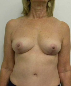 Breast Lift