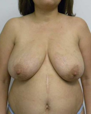 Breast Lift Case 5409 Before Photo Breast Lift