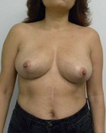 Breast Lift