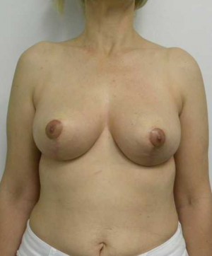 Breast Lift Case 5416 After Photo Breast Lift