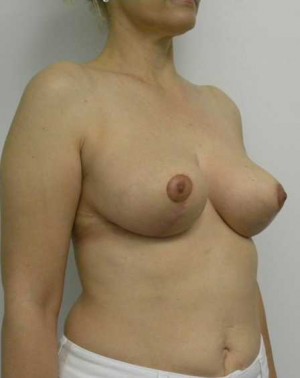 Breast Lift Case 5416 After Photo Breast Lift