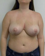 Breast Lift