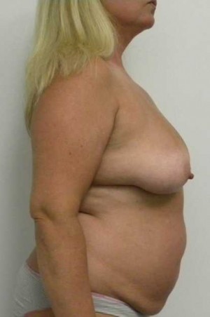 Breast Lift Case 5428 Before Photo Breast Lift