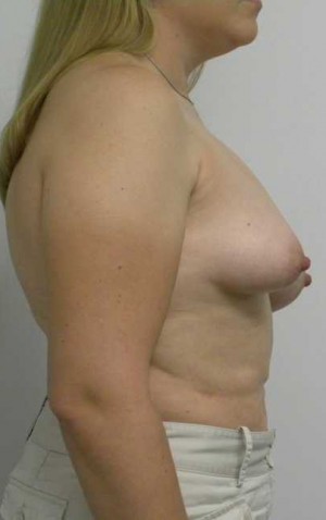 Breast Lift Case 5442 Before Photo Breast Lift