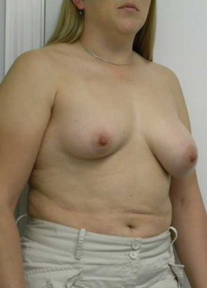 Breast Lift Case 5442 Before Photo Breast Lift