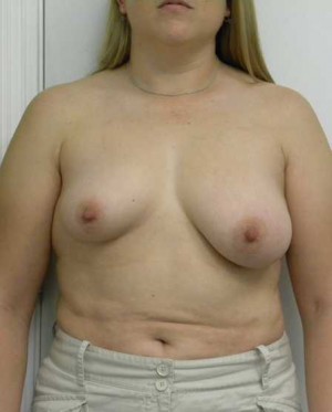 Breast Lift Case 5442 Before Photo Breast Lift
