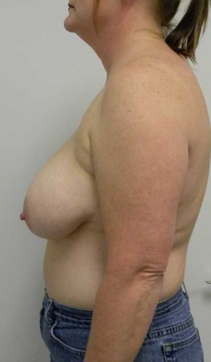 Breast Lift Case 5449 Before Photo Breast Lift