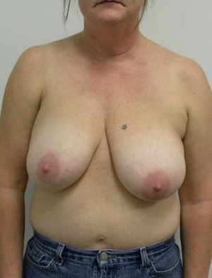 Breast Lift Case 5449 Before Photo Breast Lift