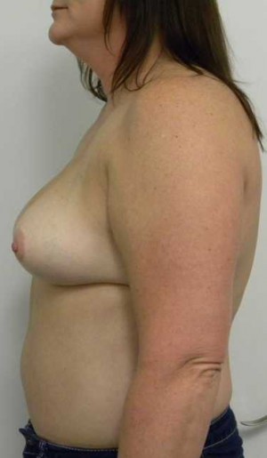 Breast Lift Case 5449 After Photo Breast Lift