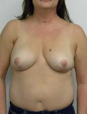 Breast Lift Case 5449 After Photo Breast Lift