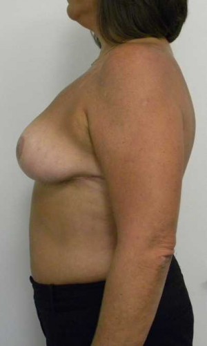 Breast Lift Case 5463 After Photo Breast Lift