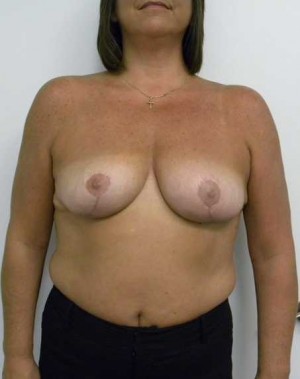 Breast Lift Case 5463 After Photo Breast Lift