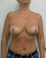 Breast Lift